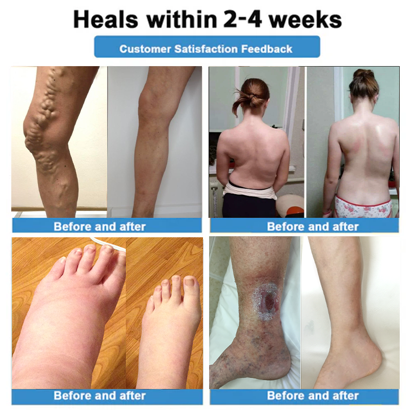 🇦🇺Healrize® 🎉4-in-1 Vein & Joint Nano Microneedle Advanced Therapy Patch🔥(Once daily, visible results in 7 days — supports arthritis, varicose veins, diabetic foot, and nerve pain.)