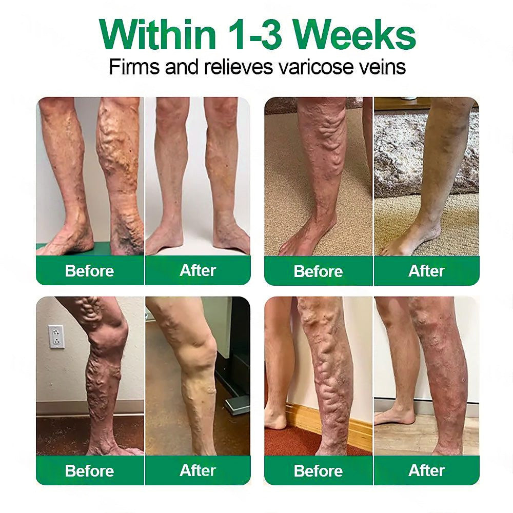 👩‍⚕️Healrize® VeinTarget Microneedle Patch⚡Instant Relief, Long-Term Results👍