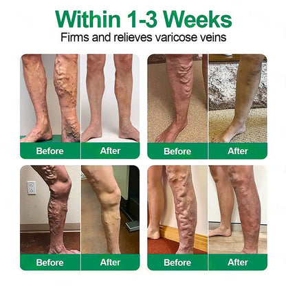 👩‍⚕️Healrize® VeinTarget Microneedle Patch⚡Instant Relief, Long-Term Results👍