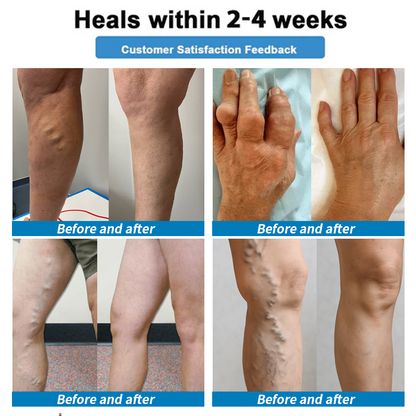 🇦🇺Healrize® 🎉4-in-1 Vein & Joint Nano Microneedle Advanced Therapy Patch🔥(Once daily, visible results in 7 days — supports arthritis, varicose veins, diabetic foot, and nerve pain.)