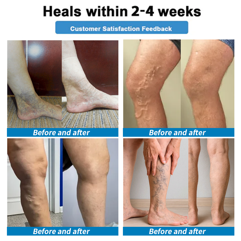 🇦🇺Healrize® 🎉4-in-1 Vein & Joint Nano Microneedle Advanced Therapy Patch🔥(Once daily, visible results in 7 days — supports arthritis, varicose veins, diabetic foot, and nerve pain.)